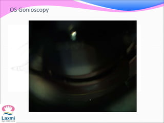 OS Gonioscopy
 