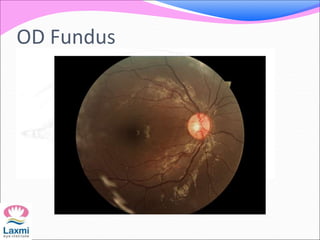 OD Fundus
 
