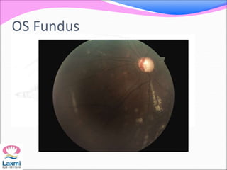 OS Fundus
 
