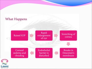 What Happens
Raised IOP
Rapid
enlargement
of eye
Stretching of
cornea
Breaks in
Descemet’s
membrane
Endothelial
barrier is
disturbed
Corneal
oedema and
clouding
 