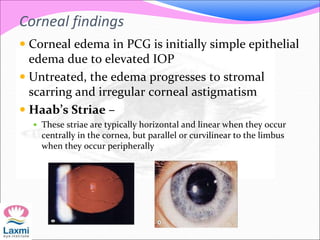 Corneal findings
 Corneal edema in PCG is initially simple epithelial
edema due to elevated IOP
 Untreated, the edema progresses to stromal
scarring and irregular corneal astigmatism
 Haab’s Striae –
 These striae are typically horizontal and linear when they occur
centrally in the cornea, but parallel or curvilinear to the limbus
when they occur peripherally
 