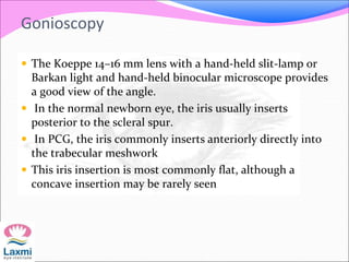 Gonioscopy
 The Koeppe 14–16 mm lens with a hand-held slit-lamp or
Barkan light and hand-held binocular microscope provides
a good view of the angle.
 In the normal newborn eye, the iris usually inserts
posterior to the scleral spur.
 In PCG, the iris commonly inserts anteriorly directly into
the trabecular meshwork
 This iris insertion is most commonly flat, although a
concave insertion may be rarely seen
 