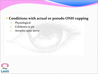  Conditions with actual or pseudo ONH cupping
A. Physiological
B. Coloboma or pit
C. Atrophic optic nerve
 