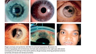 Congenital glaucoma Ophthalmology pg.pptx