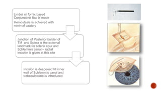Congenital Glaucoma | PPTX