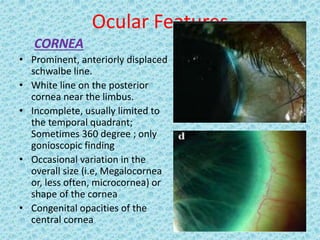 Ocular Features
CORNEA
• Prominent, anteriorly displaced
schwalbe line.
• White line on the posterior
cornea near the limbus.
• Incomplete, usually limited to
the temporal quadrant;
Sometimes 360 degree ; only
gonioscopic finding
• Occasional variation in the
overall size (i.e, Megalocornea
or, less often, microcornea) or
shape of the cornea
• Congenital opacities of the
central cornea
 