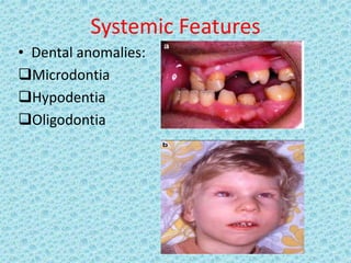 Systemic Features
• Dental anomalies:
Microdontia
Hypodentia
Oligodontia
 