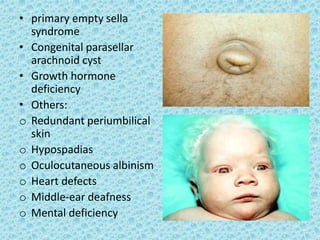 • primary empty sella
syndrome
• Congenital parasellar
arachnoid cyst
• Growth hormone
deficiency
• Others:
o Redundant periumbilical
skin
o Hypospadias
o Oculocutaneous albinism
o Heart defects
o Middle-ear deafness
o Mental deficiency
 
