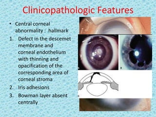 Clinicopathologic Features
• Central corneal
abnormality : hallmark
1. Defect in the descemet
membrane and
corneal endothelium
with thinning and
opacification of the
corresponding area of
corneal stroma
2. Iris adhesions
3. Bowman layer absent
centrally
 