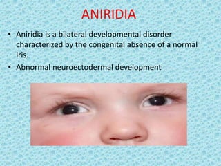 Congenital glaucoma part2; developmental glaucoma | PPTX