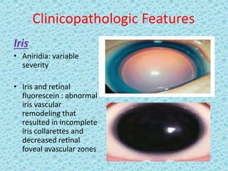 Clinicopathologic Features
Iris
• Aniridia: variable
severity
• Iris and retinal
fluorescein : abnormal
iris vascular
remodeling that
resulted in incomplete
iris collarettes and
decreased retinal
foveal avascular zones
 
