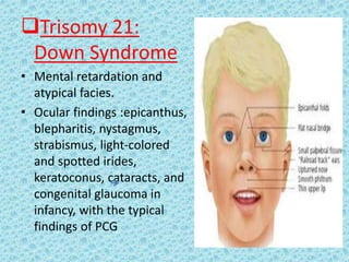 Trisomy 21:
Down Syndrome
• Mental retardation and
atypical facies.
• Ocular findings :epicanthus,
blepharitis, nystagmus,
strabismus, light-colored
and spotted irides,
keratoconus, cataracts, and
congenital glaucoma in
infancy, with the typical
findings of PCG
 