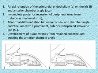 1. Partial retention of the primordial endothelium (e) on the iris (i)
and anterior chamber angle (aca);
2. Incomplete posterior recession of peripheral uvea from
trabecular meshwork (tm);
3. Abnormal differentiation between corneal and chamber angle
endothelium with a prominent, anteriorly displaced schwalbe
line (SL).
4. Development of tissue strands from retained endothelium
crossing the anterior chamber angle
 