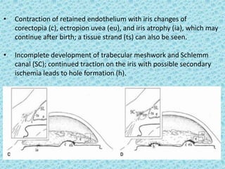 • Contraction of retained endothelium with iris changes of
corectopia (c), ectropion uvea (eu), and iris atrophy (ia), which may
continue after birth; a tissue strand (ts) can also be seen.
• Incomplete development of trabecular meshwork and Schlemm
canal (SC); continued traction on the iris with possible secondary
ischemia leads to hole formation (h).
 