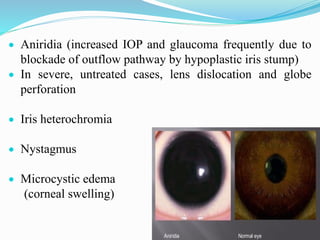  Aniridia (increased IOP and glaucoma frequently due to
blockade of outflow pathway by hypoplastic iris stump)
 In severe, untreated cases, lens dislocation and globe
perforation
 Iris heterochromia
 Nystagmus
 Microcystic edema
(corneal swelling)
 