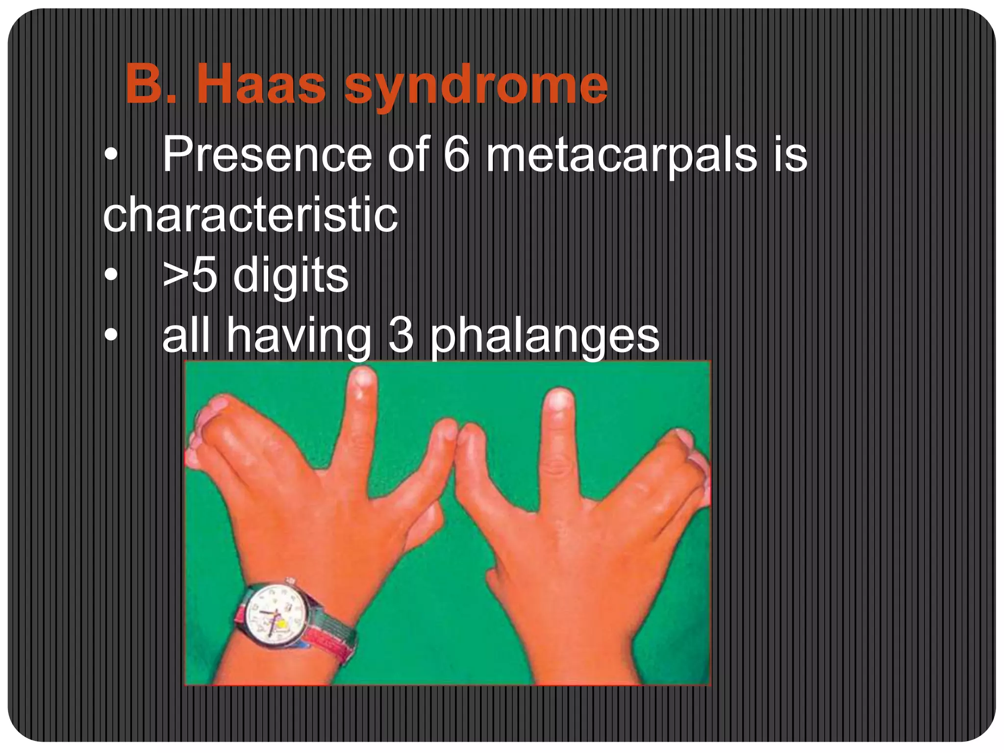 Congenital hand anomalies | PPTX