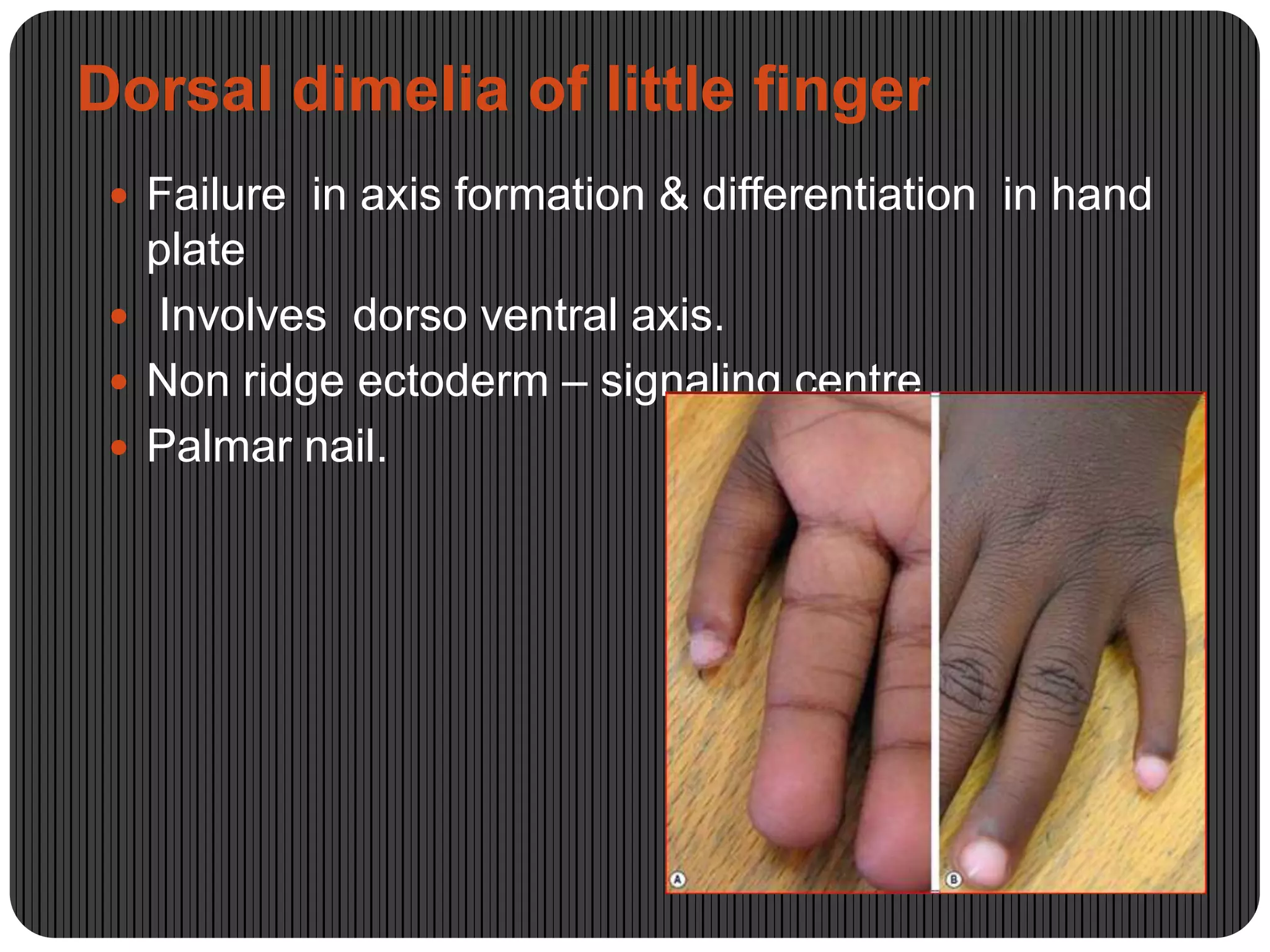 Congenital hand anomalies | PPTX