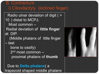 Congenital hand anomalies | PPTX