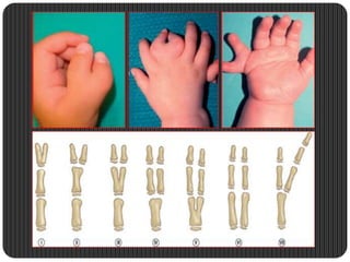 One Finger Missing Congenital hand anomalies | PPTX