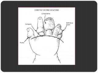 One Finger Missing Congenital hand anomalies | PPTX