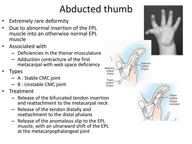 One Finger Missing Congenital hand anomalies | PPTX