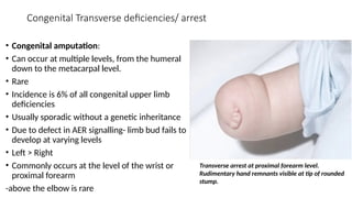 CONGENITAL HAND ANOMALIES PRESENTATION[1].pptxUPDATED 1.pptx