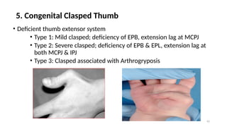 CONGENITAL HAND ANOMALIES PRESENTATION[1].pptxUPDATED 1.pptx