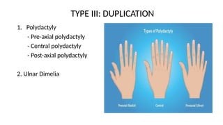 CONGENITAL HAND ANOMALIES PRESENTATION[1].pptxUPDATED 1.pptx