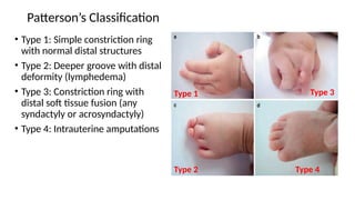 CONGENITAL HAND ANOMALIES PRESENTATION[1].pptxUPDATED 1.pptx