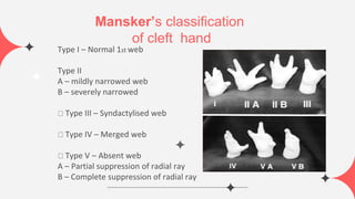 Sanders Classification Hand Descriptive congenital hand anomalies sa3d.pptx