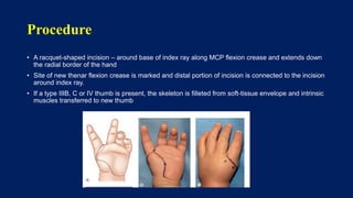 Thumb hypoplasia - congenital hand III | PPTX