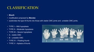 Thumb hypoplasia - congenital hand III | PPTX