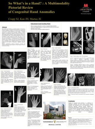 So What’s in a Hand? : A Multimodality
                        Pictorial Review
                        of Congenital Hand Anomalies
                        Crapp SJ, Kan JH, Martus JE
                                                                                                Educational Goals/Teaching Points
                                                                                                •Discuss imaging approach to a variety of congenital hand anomalies
   Abstract                                                                                     •Review the imaging findings of congenital hand anomalies and associated
                                                                                                syndromes when relevant
   When children with idiopathic or congenital anomalies of the hand are
   referred for imaging, it is important for the radiologist to succinctly and
                                                                                                •Provide relevant orthopaedic surgical perspective
   accurately describe these findings, as well as have a basic understanding
   of the clinical or surgical significance of these findings. Congenital
   anomalies of the hand have been historically classified by systems
   adopted by the International Federation of Societies for Surgery of the
   Hand (IFSSH) based on Swanson’s original classification system which
   was first proposed in 1964. As the molecular pathogenesis as a basis for
   development of these anomalies has become more clear in recent
   years, newer classification systems based on the dysmorphology of each
   entity have been proposed. (1) Although many types of congenital hand                                                                                                                               B
   anomalies occur in isolation, up to one fifth of encountered anomalies                                                                                                                                                                                                     B
   have an association with an identifiable syndrome. (2) This pictorial                                                                                                                                                          A
   review will illustrate various common and rare anomalies of the hand
                                                                                                                                                                                                                                  C                                           D
   including but not limited to brachydactyly, longitudinal epiphyseal
   bracket
   deformity, symphalangism, syndactyly, polydactyly, syndactyly, and
   clubhand. Orthopaedic surgical perspective of these findings will also be                                                                                                                    A      C
   provided when relevant.

                                                                                                                                                                    Figure 7. Apert’s Syndrome.
                                                                                      Figure 5. Phocomelia.                     Figure 6. Phocomelia
                                                                                                                                                                    Findings: PA hand (A) Syndactyly of right 2nd
                                                                                      Findings:      Absence      of     the
                                                                                      ulna, anterior displaced radius and       Findings: Absent radius and         through 4th rays. Aplasia/hypoplasia of 2nd-5th
                                                                                      single rudimentary digit. Most            ulna with single digit emanating    middle and distal phalanges. Post-axial
                                                                                      commonly         associated      with     from      the    right      upper   polysyndactyly with duplication beginning at the
                                                                                      thalidomide embryopathy but can be        extremity, with dysplasia of the    level of the middle and distal phalanx. Delta
                                                                                      sporadic      or    associated      w/                                        phalanx of the proximal phalanx of the first digit.
                                                                                      TAR, Roberts and Grebe syndromes          distal humerus.
                                                                                                                                Surgical: Prosthetic fitting may    3D CT skull (B&C) Bony synostosis of the
                                                                                      Surgical:        Observation         is                                       coronal sutures bilaterally with a brachycephalic             Figure 12. Bracket epiphysis of the 1st proximal phalanx.
                                                                                      recommended as this child will adapt      be pursued however many
                                                                                      effectively to the differences of this    children will prefer use of their   skull. Consistent with clinical features of Apert’s
                                                                                      limb.                                     own sensate limb. This child is     (not genetically proven).                                     Findings: PA radiograph(A) and Coronal GRE, T1 and PD MRI (B,C &
                                                                                                                                able to manipulate objects with                                                                   D).          Most            common        associations         include
                                                                                                                                the remaining digit.                Surgical: Priorities include correction of the                syndactyly, polydactyly, symphalangism, clubfoot, Apert's syndrome, &
                                                                                                                                                                    thumb deformity, creation of a functional first web           Poland's syndrome. Curved physis (green arrows) of the 1st proximal
                                                                                                                                                                    space, and release of finger syndactylies /                   phalanx makes a C-shaped band extending and surrounding the metaphyses
                                                                                                                                                                    synostosis. Ablation of the postaxial polydactyly             with resultant deformity of the bone.
                                                                                                                                                                    may be considered.
                                                                                                                                                                                                                                  Surgical: Longitudinal epiphyseal bracket can lead to progressive
                                                                                                                                                                                                                                  deformity via asymmetric growth. Resection of the abnormal central
                                                                                                                                                                                                                                  physis with fat graft interposition can allow for more normal growth.
                                                                                                                                                                                                                                  Transverse corrective osteotomy may be combined with bracket excision to
                                                                                                                                                                                                                                  provide acute correction of the deformity.


Figure 1. Thumb hypoplasia.               Figure 2. Radial deficiency.
Findings: Complete absence of the         Findings: Complete absence of the
thumb in a patient with Type V thumb      radius in patient with
hypoplasia and genetically confirmed      thrombocytopenia absent radius
Holt-Oram Syndrome. Note the mild         (TAR) syndrome. Note the radial
clinodactyly of the 2nd through 5th       angulation of the hand at the level of
digits and radial deviation of the hand   the wrist and near normal appearance
at the level of the wrist.                of the thumb, a unique finding seen in
                                          TAR.                                       Figure 8. Brachydactyly.
Surgical: Index finger pollicization
would be recommended. This is a           Surgical: A carpal centralization          Findings: Foreshortening of the 4th
complex procedure where the index         procedure would be considered to           digit and deformed 4th and 5th
finger is reconstructed to act as a       improve function and appearance.           middle phalanges. The middle
thumb.                                                                               phalanges of the 2nd -5th rays are         Figure 9. Brachydactyly and
                                                                                     short.                                     symphalangism.
                                                                                                                                                                         Figure 10. Polydactyly.
                                                                                                                                Findings: Fusion of the capitate and     Findings: Preaxial polydactyly with          A                                 B                                C
                                                                                     Surgical: 4th   /5th
                                                                                                       middle phalangeal
                                                                                     osteotomy could be considered.             hamate bones. Short 1st MC bone.         hypoplastic radial digit which has two
                                                                                                                                Absent middle phalanges from the 2nd     ossification centers and articulates with        Figure 13. Lunotriquetral coalition.
                                                                                     Otherwise, if the hand is
                                                                                     functional, observation would be           -5th rays & clinodactyly of the 5th      a bifid 1st MC head (yellow arrow).              Findings: PA radiograph (A) and coronal T1 & PD FS MRI (B & C) of the hand.
                                                                                     recommended.                               finger.                                  Surgical: This Wassel 4 thumb                    Incomplete separation of the lunate and triquetral bones in a patient with
                                                                                                                                                                         duplication would require ablation of            lunotriquetral coalition. This is the most common carpal coalition. Common
                                                                                                                                Surgical: If the hand is                 the radial digit, reconstruction of the          associated syndromes include Ellis-van Crevald, Holt-Oram and Turner. Occurs
                                                                                                                                functional, observation would be         lateral collateral ligament of the MCP           more commonly in females and those of African descent.
                                                                                                                                recommended.                             joint, and repair of the insertion of the
                                                                                                                                                                                                                          Surgical: Observation would be recommended for this asymptomatic radiographic
                                                                                                                                                                         thumb intrinsics.
                                                                                                                                                                                                                          finding.




                                                                                                                                                                                                                           Conclusion
                                                                                                                                                                                                                           Imaging of congenital hand anomalies is a challenge for
                                                                                                                                                                                                                           radiologists unfamiliar with these entities. Various imaging
                                          Figure 4. Constriction band
                                          syndrome.                                                                                                                                                                        modalities and techniques aid in the determination of the
                                                                                                                                                                                                                           underlying pathology allowing accurate diagnosis. A
                                          Findings: Amputation of the 2nd
                                          through 5th rays at the level of the
                                                                                                                                                                                                                           fundamental understanding of these anomalies as well as their
Figure 3. Amniotic band syndrome.         proximal middle phalanges with              Figure 11. Isolated Triphalangeal thumb                                                                                              associated syndromes when applicable, allows early and accurate
Findings: Amputation of the 1st
                                          multiple soft tissue constrictions (blue    (TPT).                                                                                                                               detection by the radiologist, thereby providing valuable
                                          arrows). Syndactyly of the 3rd and 4th                                                                                                                                           diagnostic data to referring physicians in the management of this
through 4th digits at the level
                                          rays. The thumb is intact.                  Findings: Extra middle phalanx of the                                                                                                unique                      patient                  population.
proximal phalanges with
                                          Surgical: Constriction ring release         thumb. The middle phalanx may be
characteristic soft tissue constriction
                                          may be considered if of functional          triangular, trapezoidal, or rectangular.
(red arrows) related to amniotic band
                                          and cosmetic benefit. Syndactyly            Isolated TPT occurs in opposable & non-
syndrome. Note soft tissue syndactyly
                                                                                      opposable forms. TPT has associations with
between the 3rd and 4th rays.             release would be recommended.
                                                                                      a number of syndromes including many
Surgical: Syndactyly release would                                                    with hand & foot anomalies and AD
                                                                                                                                                                                                                           References:
be recommended.                                                                       inheritance.
                                                                                                                                                                                                                           1. Oberg et al, “Developmental Biology and Classification of Congenital Anomalies of
                                                                                      Surgical: Priorities include 1) adequate 1st                                                                                         the Hand and Upper Extremity”, J Hand Surgery (2010) 35A:2066–2076.
                                                                                                                                                                                                                           2. Watts, A.C., Hooper, G., “(iii) Congenital hand anomalies” from Mini-Symposium:
                                                                                      web space → web deepening 2) lack of
                                                                                                                                                                                                                           Children’s Orthopedic Surgery in Current Orthopaedics (2006) 20:266–273
                                                                                      opposition → tendon transfer to restore                                                                                              3. Linder et al, “Congenital Anomalies of the Hand: An Overview”, J Craniofacial
                                                                                      opposition 3) angular deformity →                                                                                                    Surgery (2009) 20:999-1004
                                                                                      osteotomy and / or fusion of the abnormal                                                                                            4. Chavan et al, “Twenty classic hand radiographs that lead to diagnosis.” Pediatric
                                                                                      middle phalanx to the proximal or distal                                                                                             Radiology (2010) 40:747–761
                                                                                      phalanx.
 