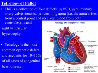 Tetrology of Fallot
• This is a collection of four defects: (1) VSD, (2) pulmonary
artery valve stenosis, (3) overriding aorta (i.e. the aorta arises
from a central point and receives blood from both
ventricles), (4) and
right ventricular
hypertrophy.
• Tetralogy is the most
common cyanotic defect
and accounts for 10–15%
of all cases of congenital
heart disease.
 
