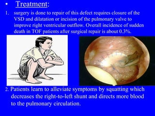 • Treatment:
1. surgery is done to repair of this defect requires closure of the
VSD and dilatation or incision of the pulmonary valve to
improve right ventricular outflow. Overall incidence of sudden
death in TOF patients after surgical repair is about 0.3%.
2. Patients learn to alleviate symptoms by squatting which
decreases the right-to-left shunt and directs more blood
to the pulmonary circulation.
 