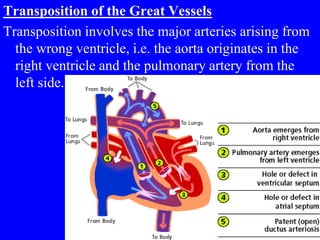 Transposition of the Great Vessels
Transposition involves the major arteries arising from
the wrong ventricle, i.e. the aorta originates in the
right ventricle and the pulmonary artery from the
left side.
 