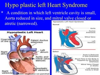 Hypo plastic left Heart Syndrome
* A condition in which left ventricle cavity is small,
Aorta reduced in size, and mitral valve closed or
atretic (narrowed).
 