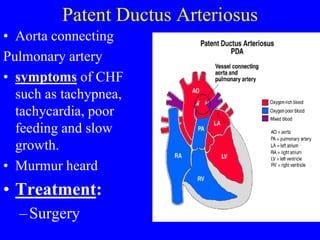Patent Ductus Arteriosus
• Aorta connecting
Pulmonary artery
• symptoms of CHF
such as tachypnea,
tachycardia, poor
feeding and slow
growth.
• Murmur heard
• Treatment:
–Surgery
 