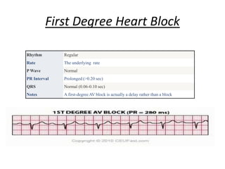 Rhythm Regular
Rate The underlying rate
P Wave Normal
PR Interval Prolonged (>0.20 sec)
QRS Normal (0.06-0.10 sec)
Notes A first-degree AV block is actually a delay rather than a block
First Degree Heart Block
 
