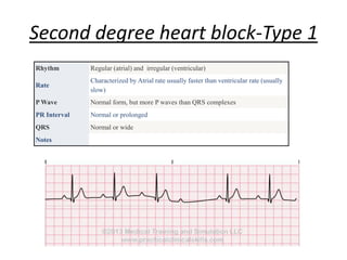 Second degree heart block-Type 1
Rhythm Regular (atrial) and irregular (ventricular)
Rate
Characterized by Atrial rate usually faster than ventricular rate (usually
slow)
P Wave Normal form, but more P waves than QRS complexes
PR Interval Normal or prolonged
QRS Normal or wide
Notes
 