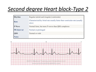 Second degree Heart block-Type 2
Rhythm Regular (atrial) and irregular (ventricular)
Rate
Characterized by Atrial rate usually faster than ventricular rate (usually
slow)
P Wave Normal form, but more P waves than QRS complexes
PR Interval Normal or prolonged
QRS Normal or wide
Notes
 