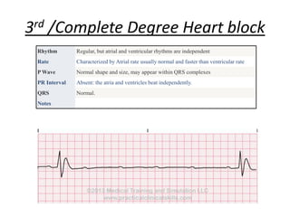3rd /Complete Degree Heart block
Rhythm Regular, but atrial and ventricular rhythms are independent
Rate Characterized by Atrial rate usually normal and faster than ventricular rate
P Wave Normal shape and size, may appear within QRS complexes
PR Interval Absent: the atria and ventricles beat independently.
QRS Normal.
Notes
 