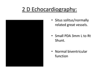 2 D Echocardiography:
• Situs solitus/normally
related great vessels.
• Small PDA 3mm L to Rt
Shunt.
• Normal biventricular
function
 