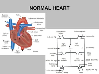 NORMAL HEART
 