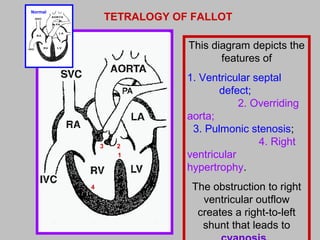 Normal
This diagram depicts the
features of
1. Ventricular septal
defect;
2. Overriding
aorta;
3. Pulmonic stenosis;
4. Right
ventricular
hypertrophy.
The obstruction to right
ventricular outflow
creates a right-to-left
shunt that leads to
TETRALOGY OF FALLOT
1
23
4
 