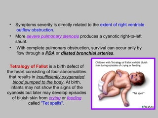 Tetralogy of Fallot is a birth defect of
the heart consisting of four abnormalities
that results in insufficiently oxygenated
blood pumped to the body. At birth,
infants may not show the signs of the
cyanosis but later may develop episodes
of bluish skin from crying or feeding
called "Tet spells".
• Symptoms severity is directly related to the extent of right ventricle
outflow obstruction.
• More severe pulmonary stenosis produces a cyanotic right-to-left
shunt.
• With complete pulmonary obstruction, survival can occur only by
flow through a PDA or dilated bronchial arteries.
 