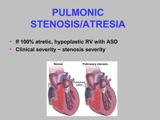 PULMONIC
STENOSIS/ATRESIA
• If 100% atretic, hypoplastic RV with ASD
• Clinical severity ~ stenosis severity
 
