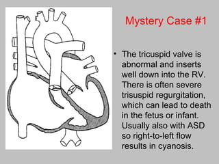 Mystery Case #1
• The tricuspid valve is
abnormal and inserts
well down into the RV.
There is often severe
trisuspid regurgitation,
which can lead to death
in the fetus or infant.
Usually also with ASD
so right-to-left flow
results in cyanosis.
 