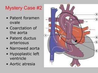 • Patent foramen
ovale
• Coarctation of
the aorta
• Patent ductus
arteriosus
• Narrowed aorta
• Hypoplastic left
ventricle
• Aortic atresia
Mystery Case #2
 