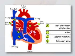 Congenital heart defects | PPTX
